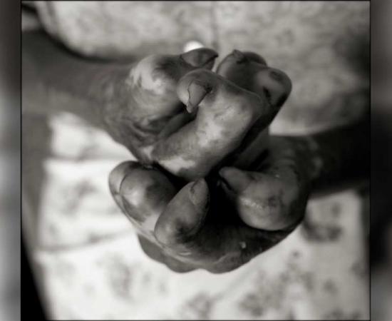 The hands of a person with leprosy. Source: paul salmon/EyeEm / Adobe Stock